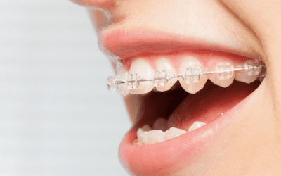 Best Invisible Braces: A Guide to Straighter Teeth Options