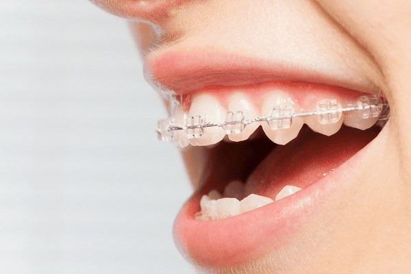 Best Invisible Braces: A Guide to Straighter Teeth Options